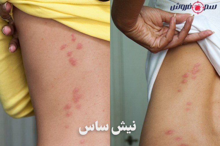 جای نیش ساس