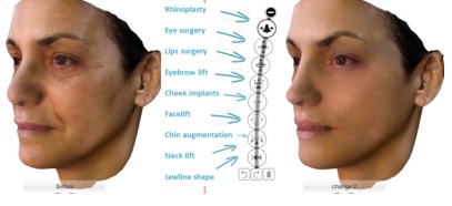 هوش مصنوعی عمل بینی Crisalix 